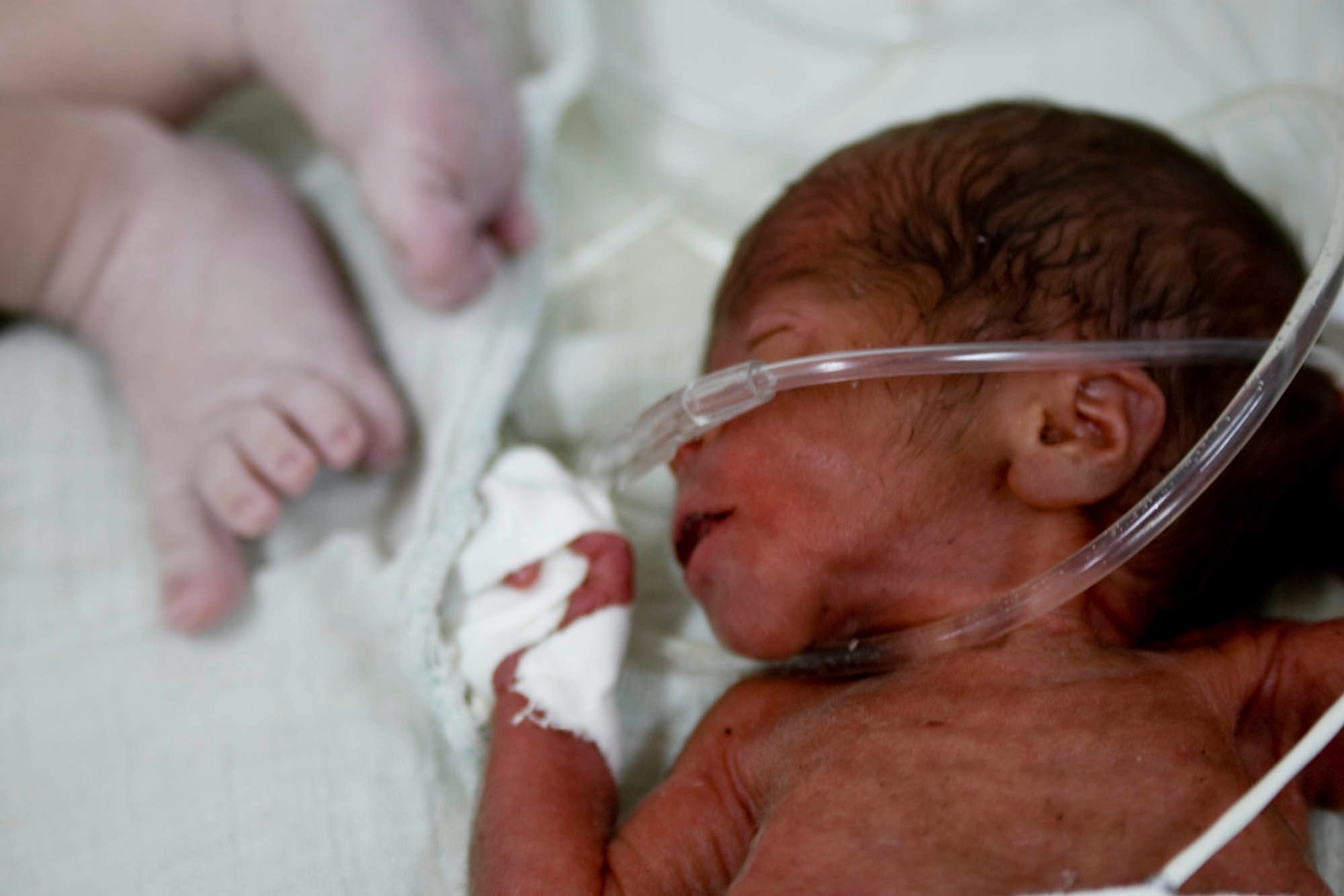 premature infant in hospital with breathing tubes